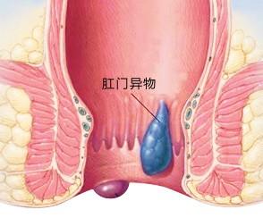 肛门出现疼痛是得了什么病怎么治疗