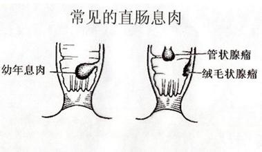直肠息肉百科
